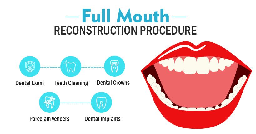 Full-Mouth-Reconstruction-Procedure