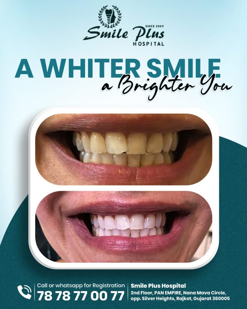 Professional Teeth Whitening: A Safe and Effective Way to Brighten Your Smile