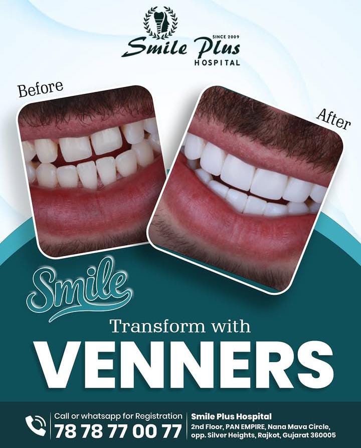 Dental Veneers: Transform Your Smile with a Natural, Confident Look