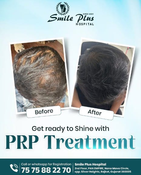 PRP Hair Treatment in Rajkot: A Natural Solution for Hair Thinning and Hair Loss
