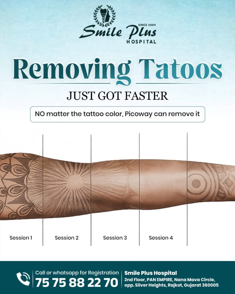 Advanced Tattoo Removal in Rajkot: A Complete Guide to PicoWay Laser Treatment at Smile Plus Hospital