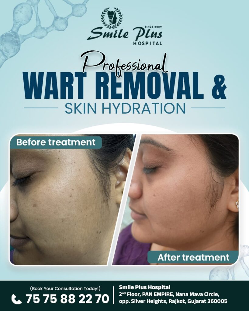 Professional Wart Removal & Skin Hydration in Rajkot