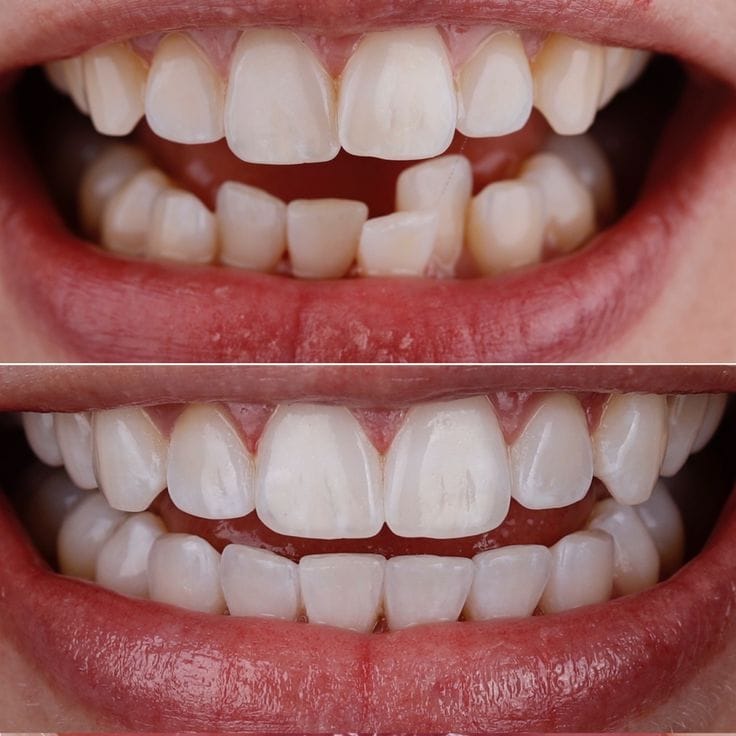 Invisible Aligners Before and After