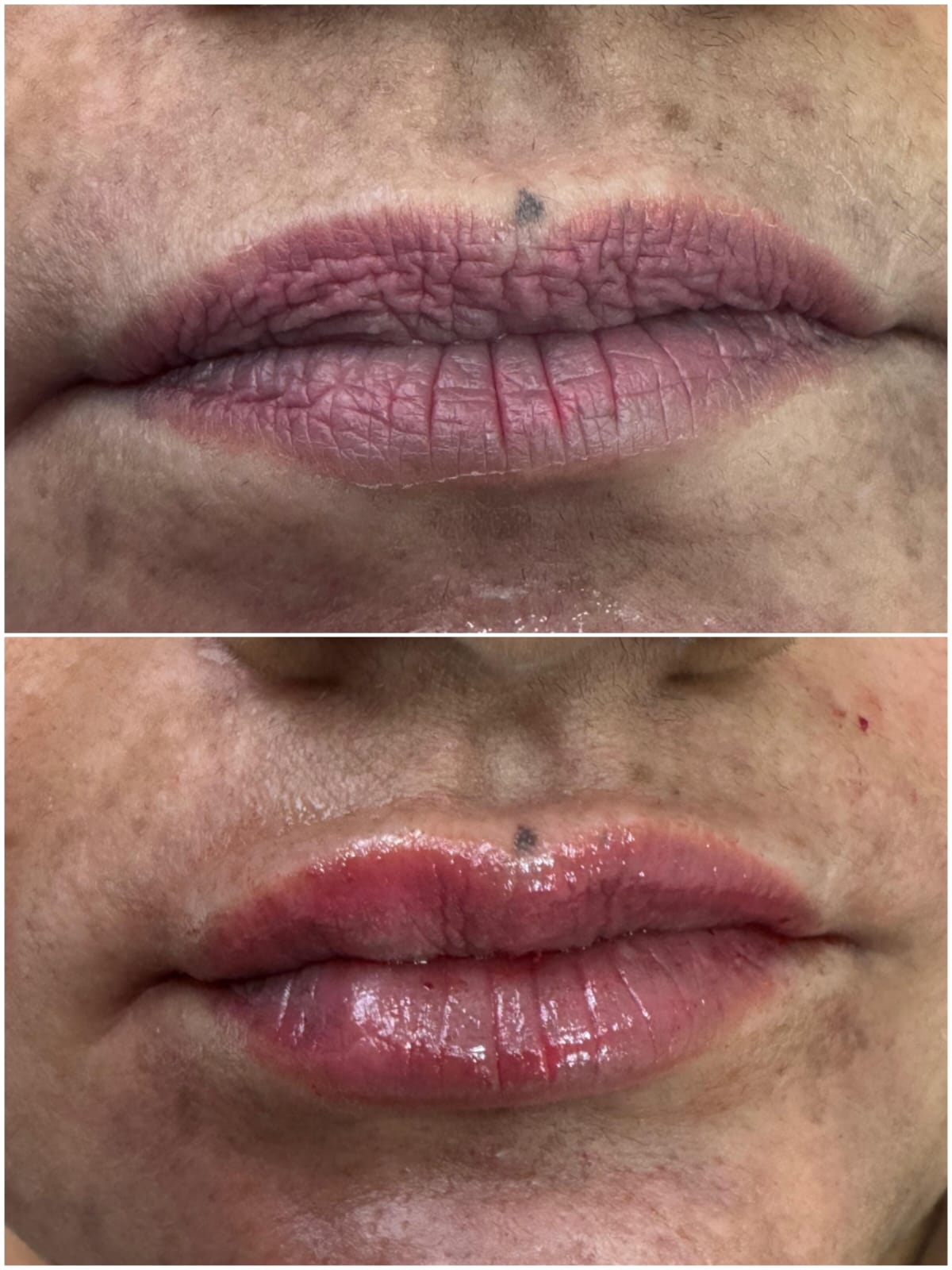 Lip Pigmentation Treatment Before and After