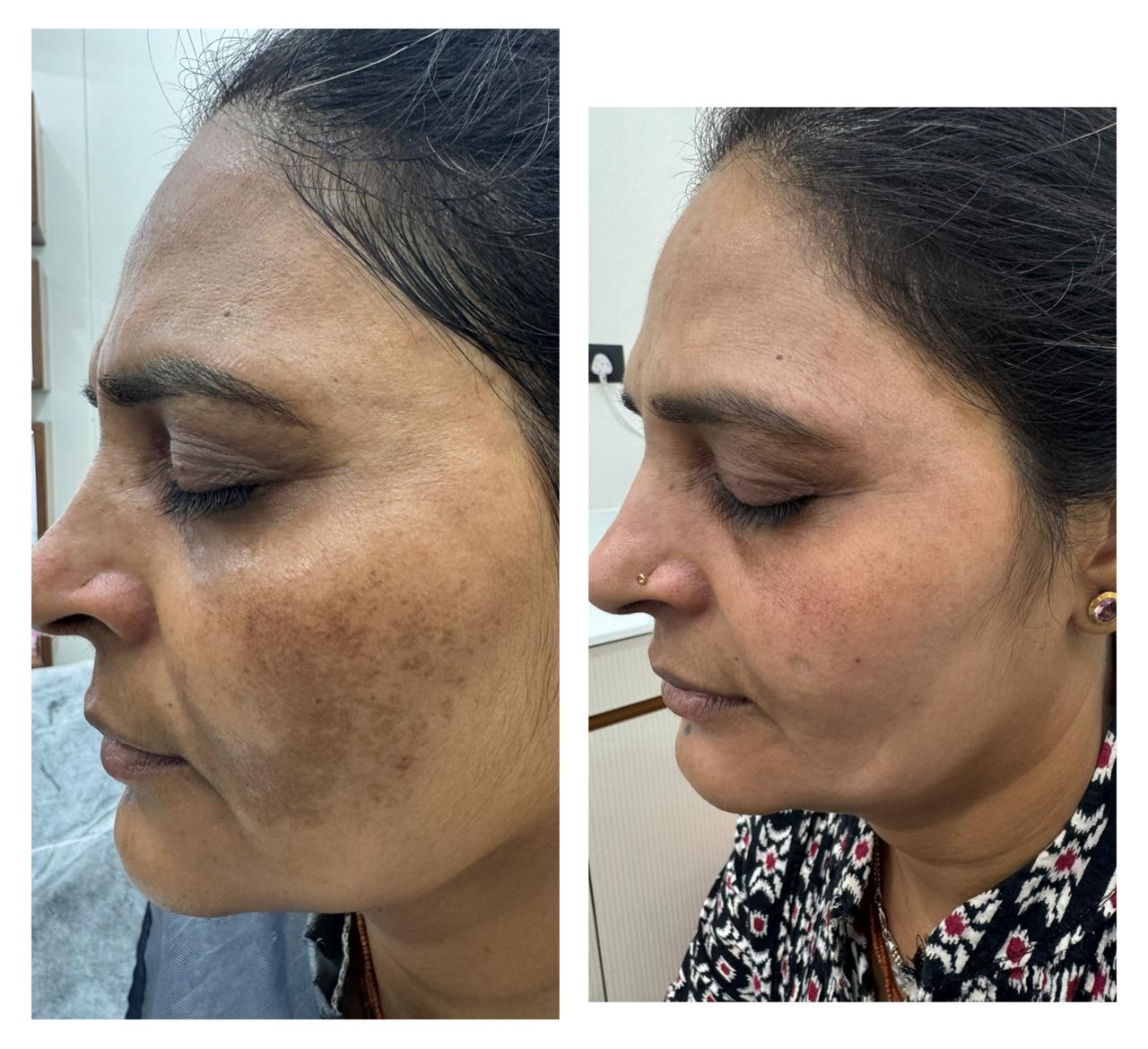 Melasma Treatment Before and After