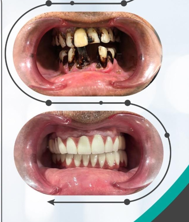 Dental Implants Before and After