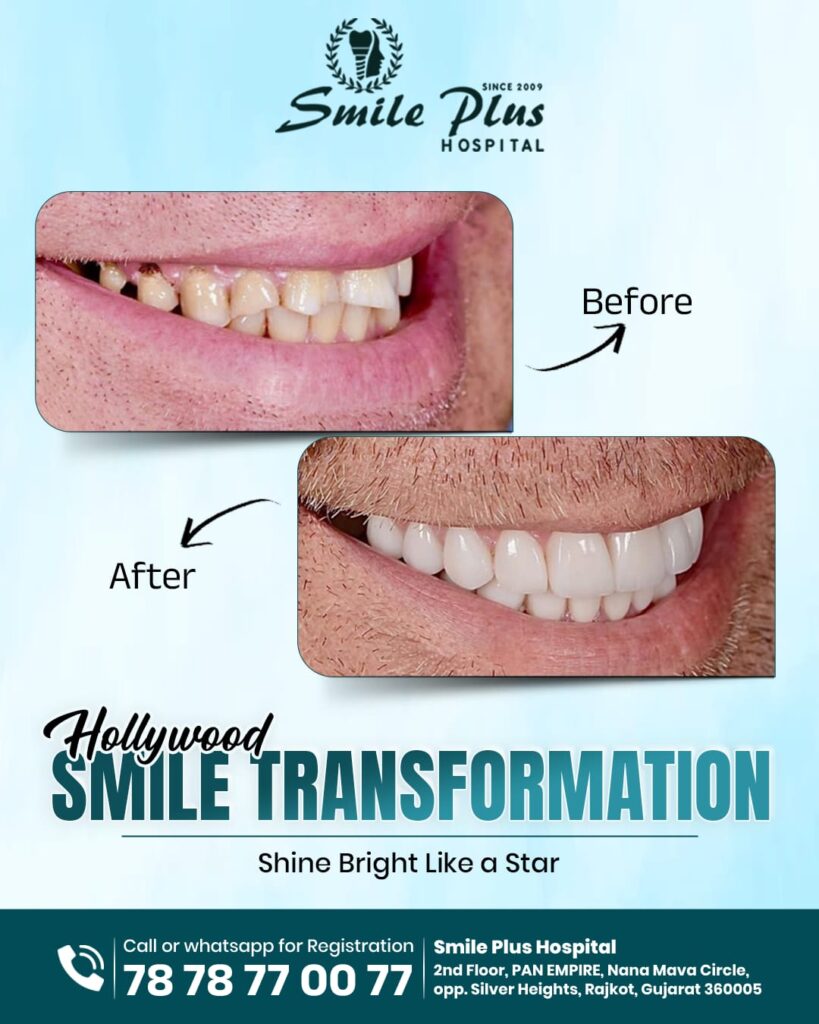 Get a Camera-Ready Smile — Hollywood Smile Makeovers in Rajkot