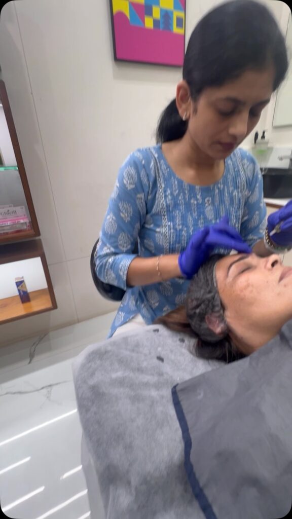 Say Goodbye to Pigmentation & Dark Spots with Yellow Peel Therapy in Rajkot